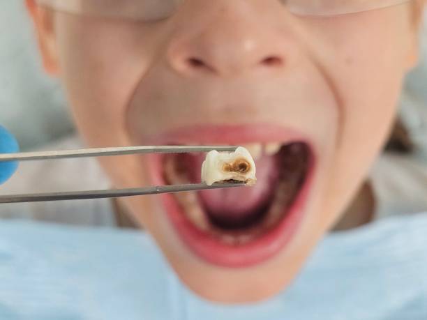 Best Urgent Care for Lost Fillings or Crowns in Southmayd, TX